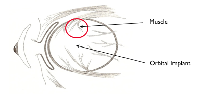 The eye muscles attach to the orbital implant